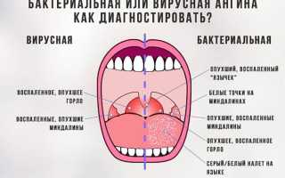 Ангина у ребенка. Причины, симптомы, лечение и профилактика ангины
