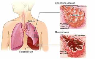 Пневмония у ребенка. Причины, симптомы и лечение воспаления легких у детей