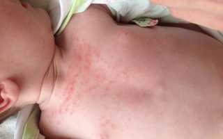 Потница у ребенка. Причины, симптомы, лечение и профилактика потницы