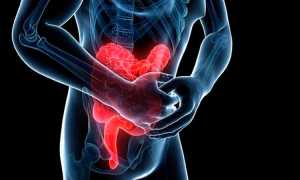 Болезнь Крона: к какому врач обращаться, симптомы, лечение