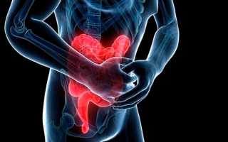 Болезнь Крона: к какому врач обращаться, симптомы, лечение