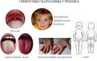 Скарлатина у ребенка. Причины, симптомы, лечение, профилактика скарлатины