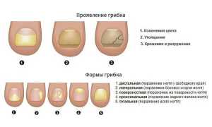 Грибок ногтей у детей. Причины, симптомы и лечение онихомикоза