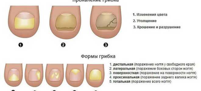 Грибок ногтей у детей. Причины, симптомы и лечение онихомикоза