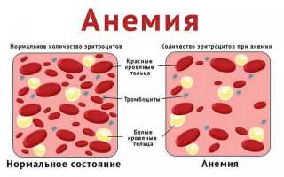 Анемия у ребенка. Причины, симптомы, лечение и профилактика малокровия