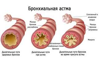 Астма у ребенка. Причины, симптомы, лечение и профилактика астмы у детей