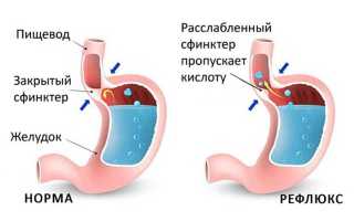 Изжога у ребенка. Причины, симптомы, лечение и профилактика изжоги