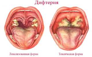 Дифтерия у ребенка. Причины, симптомы, лечение и профилактика дифтерии