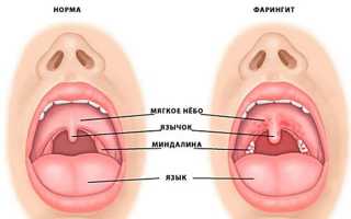 Фарингит у ребенка. Причины, симптомы, лечение и профилактика фарингита