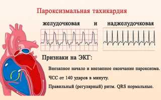 Пароксизмальная наджелудочковая тахикардия