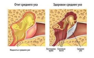 Отит у ребенка. Причины, симптомы, лечение и профилактика отита у детей