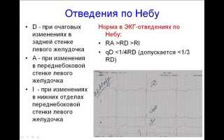 Отведения по Нэбу. Отведение по Гуревичу. Отведение по Клетэну.