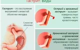 Гастрит у ребенка. Причины, симптомы, лечение и профилактика гастрита