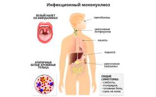 Мононуклеоз у ребенка. Причины, симптомы и лечение мононуклеоза
