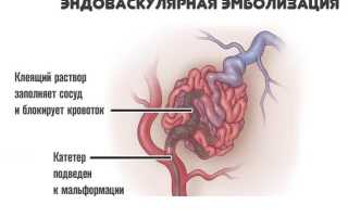 Эндоваскулярная эмболизация сосудов как метод удаления новообразований