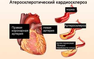 Причины и лечение атеросклеротического кардиосклероза