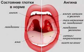 Виды ангины у ребенка. Когда нужно обращаться к врачу?