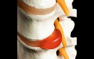 Межпозвоночная грыжа: что это, причины возникновения и кто ее лечит