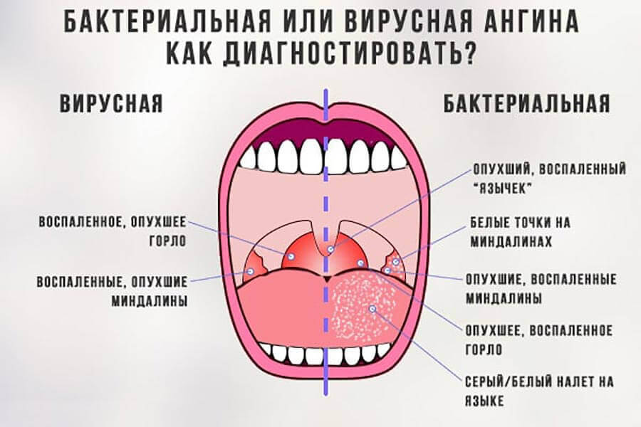 Бактериальная и вирусная ангина у детей