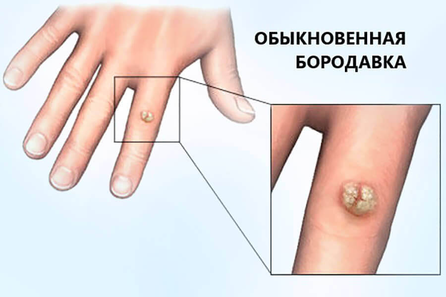 Бородавка