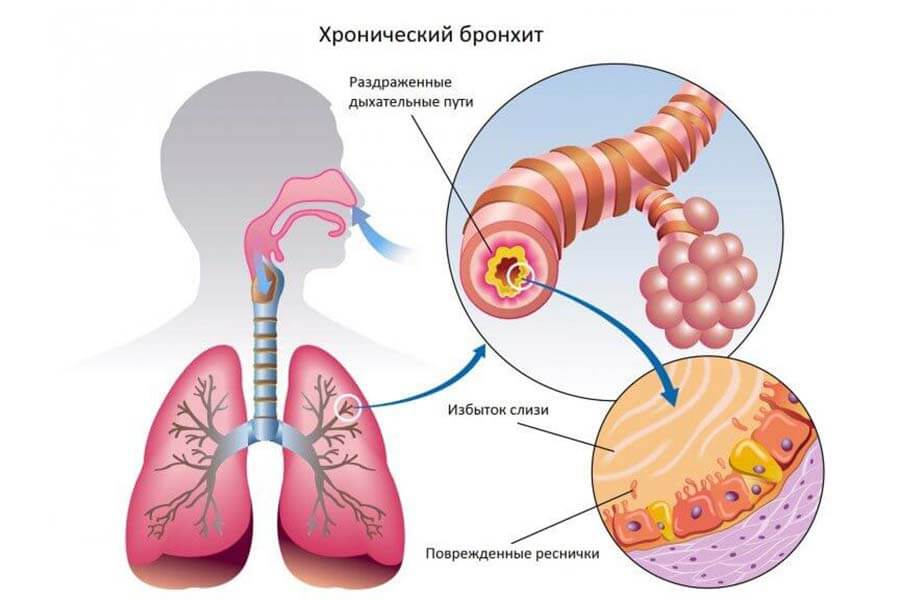 Бронхит