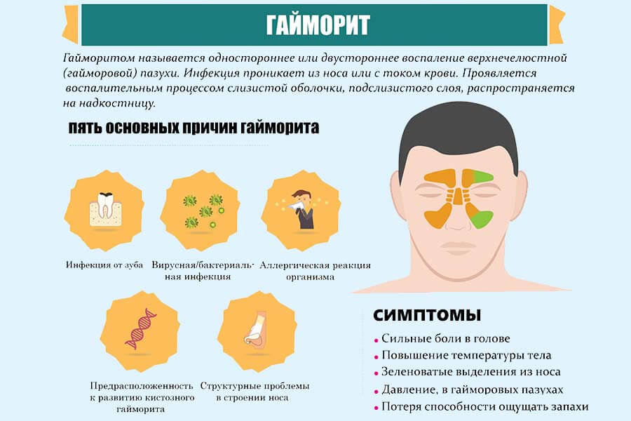 Гайморит