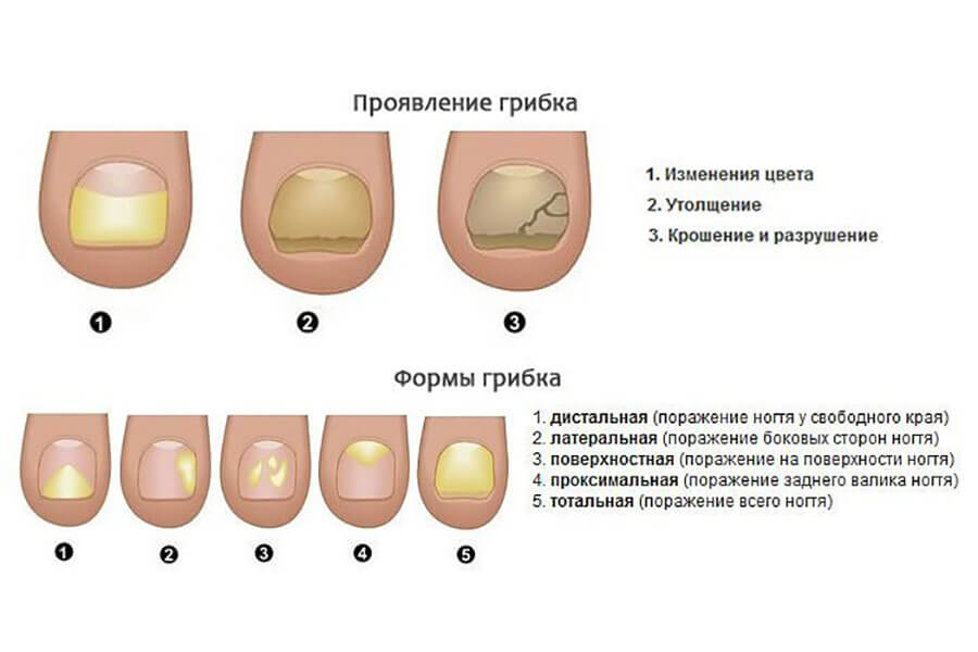 Грибок ногтей
