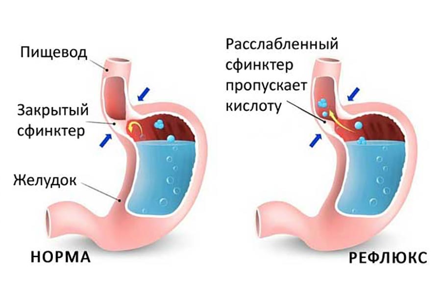 Рефлюкс