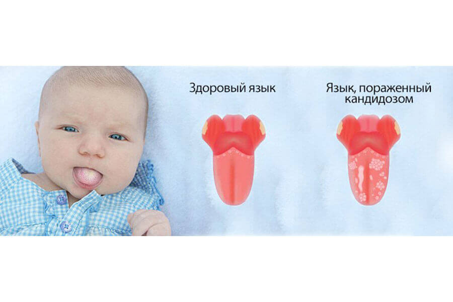 Симптомы кандидоза у детей