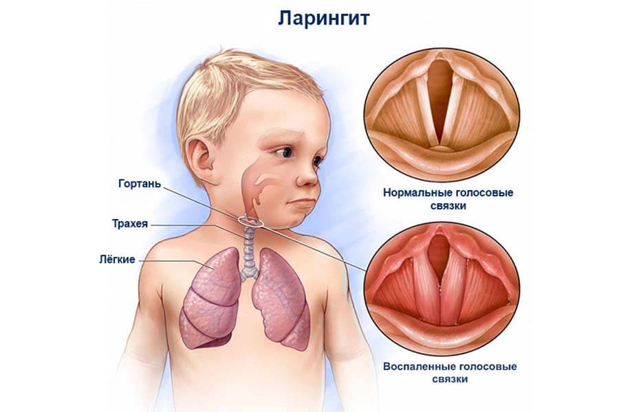 Ларингит
