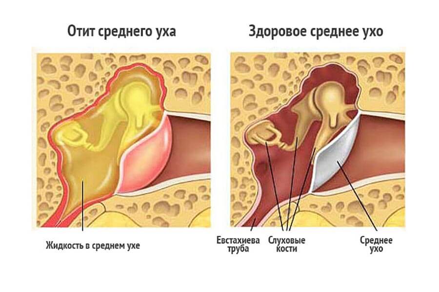 Симптомы отита у детей