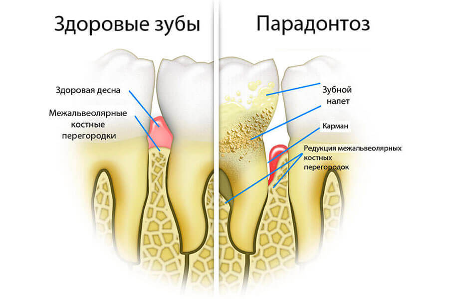 Пародонтоз