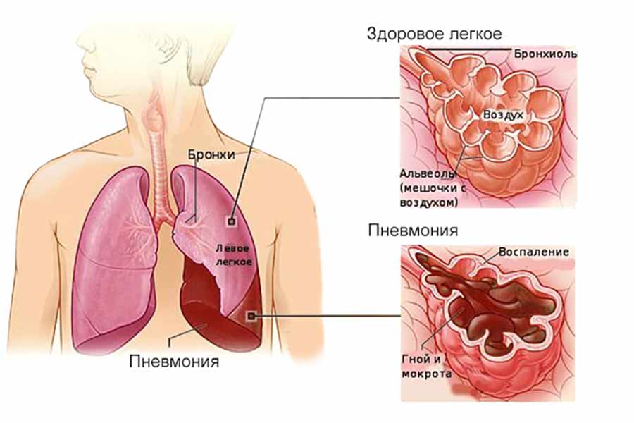 Симптомы пневмонии