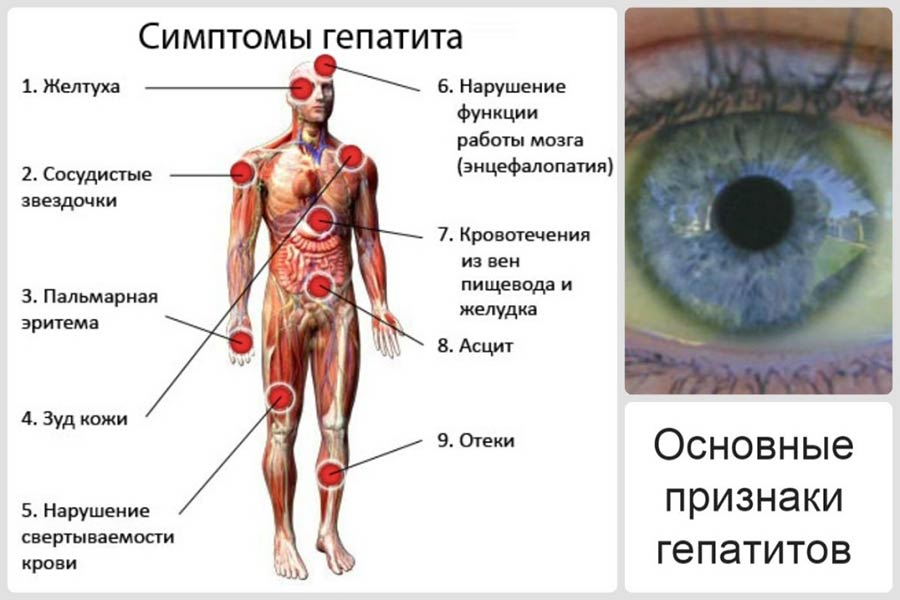 Симптомы гепатита