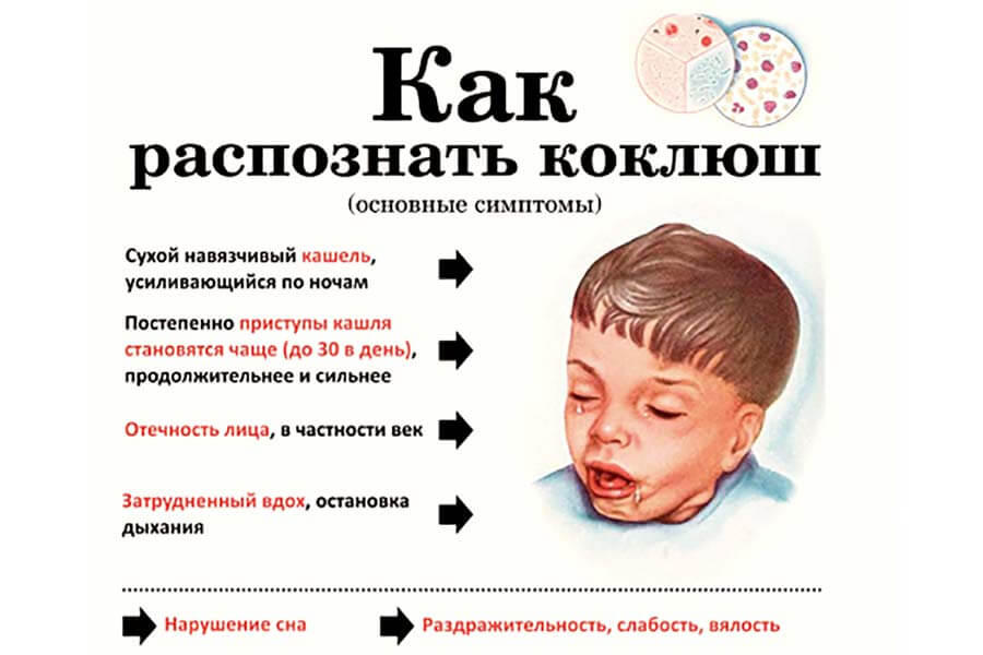 Симптомы коклюша у ребенка