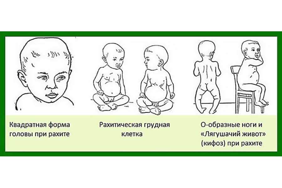 Симптомы рахита у ребенка