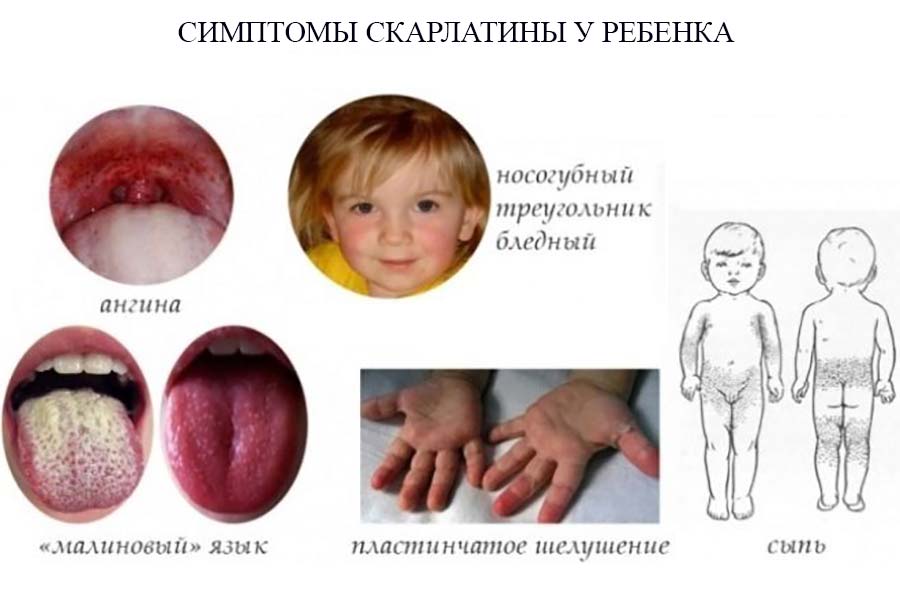 Симптомы скарлатины у ребенка