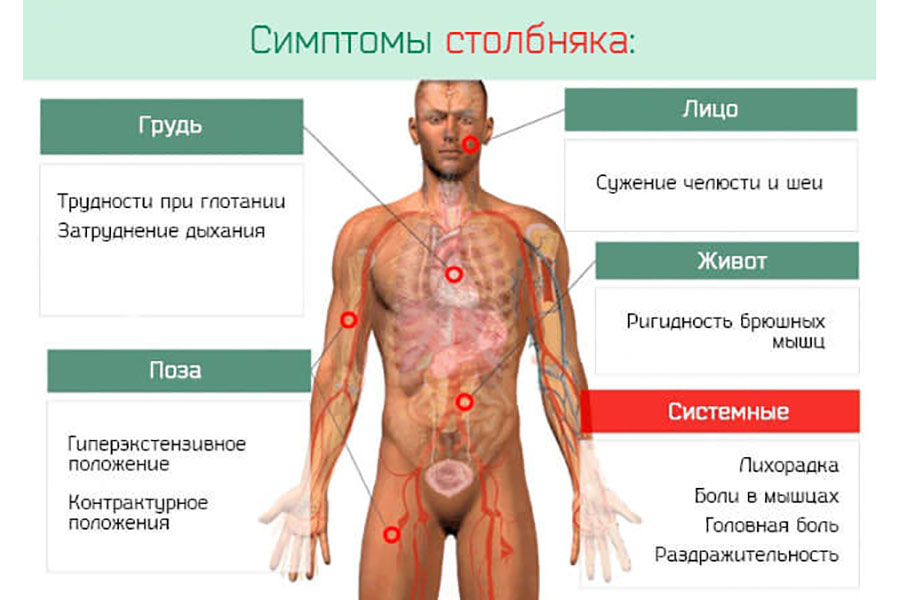 Симптомы столбняка
