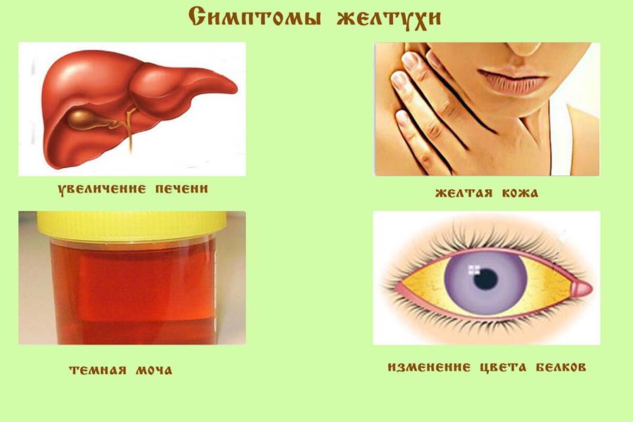 Симптомы желтухи у ребенка