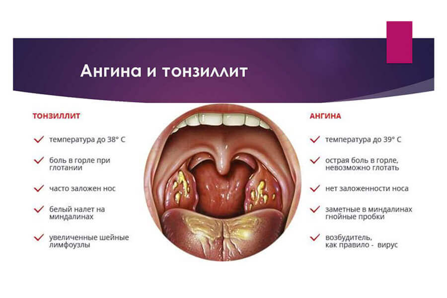 Тонзиллит и ангина