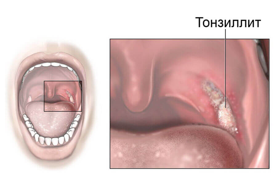 Тонзиллит