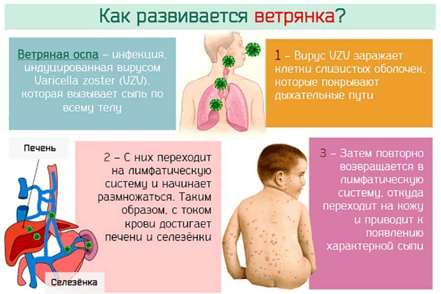 Ветряная оспа