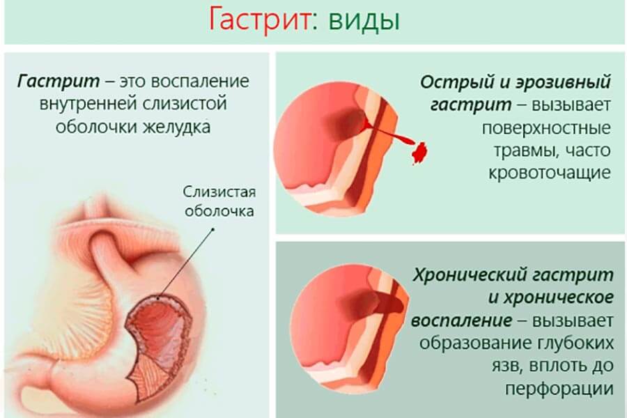 Виды гастрита у детей