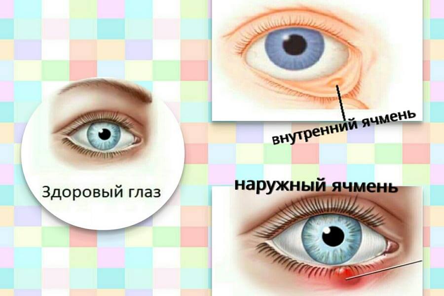 Ячмень у ребенка