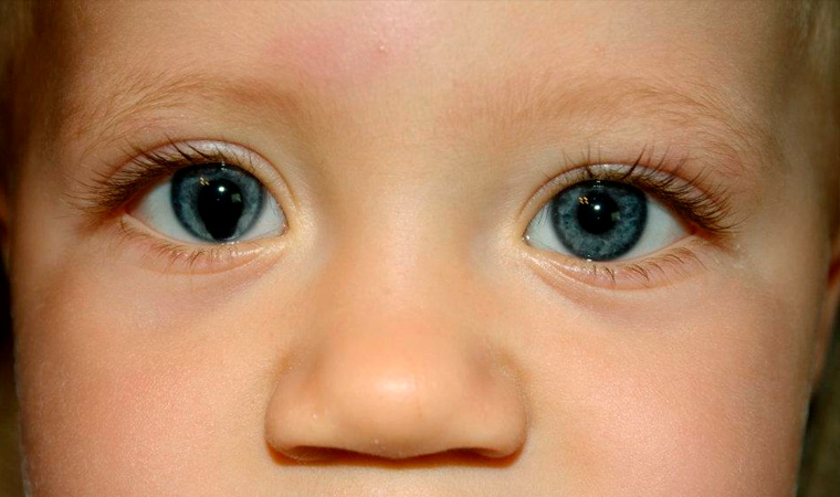 Анизокория у детей