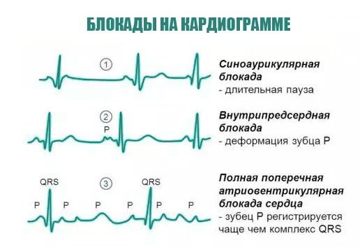 Блокада сердца
