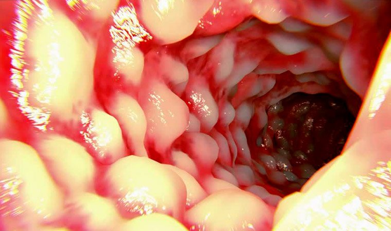 Болезнь Крона