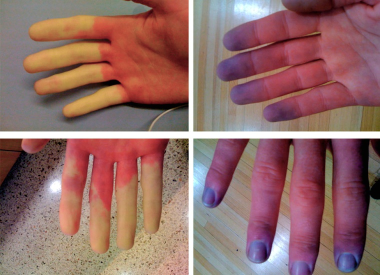 Синдром Рейно