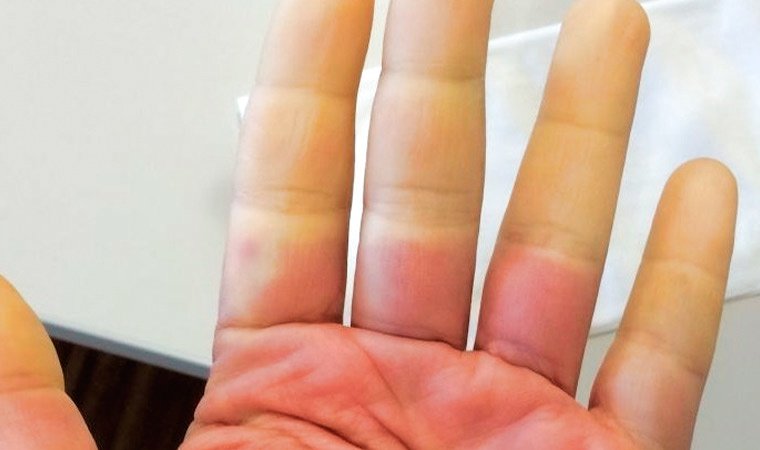 Болезнь Рейно