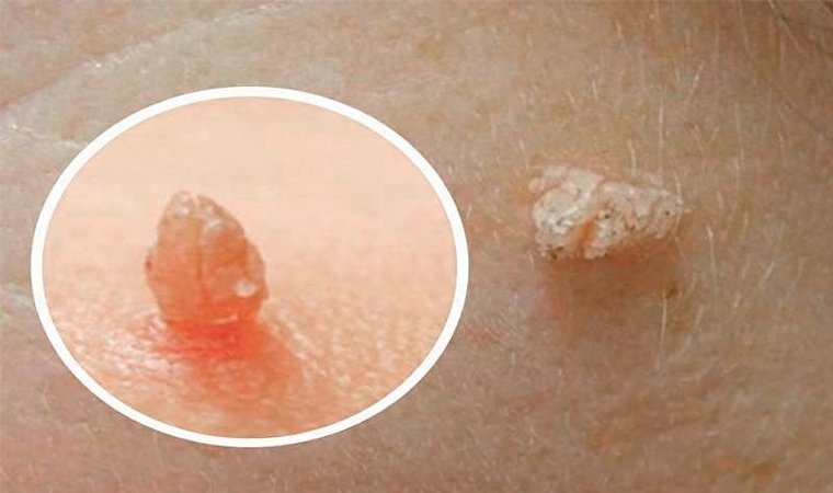 большие папилломы